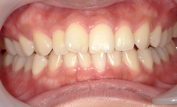 部分矯正 上下の部分矯正の症例写真