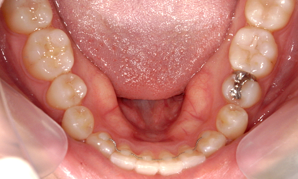 部分矯正 上下の部分矯正の症例写真