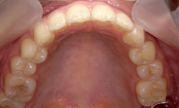 部分矯正 上下の部分矯正の症例写真