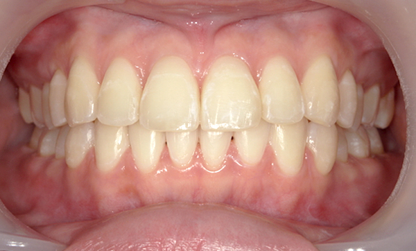 部分矯正 上下の部分矯正の症例写真