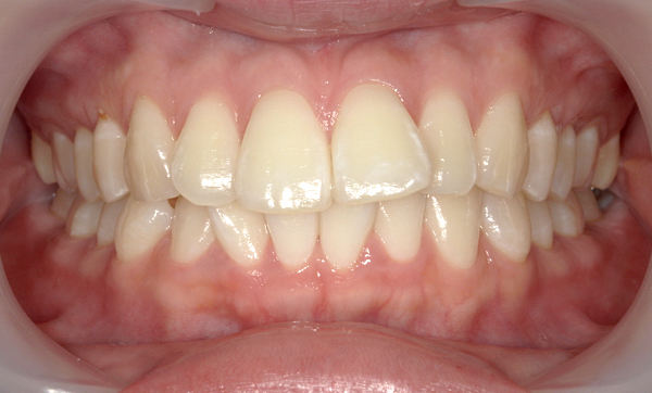 部分矯正 上下の部分矯正の症例写真