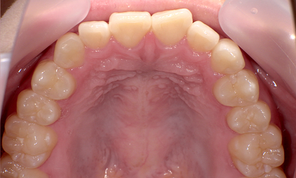 部分矯正 上下の部分矯正の症例写真