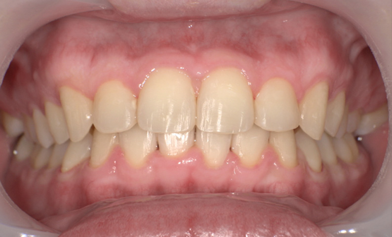 部分矯正 上下の部分矯正の症例写真