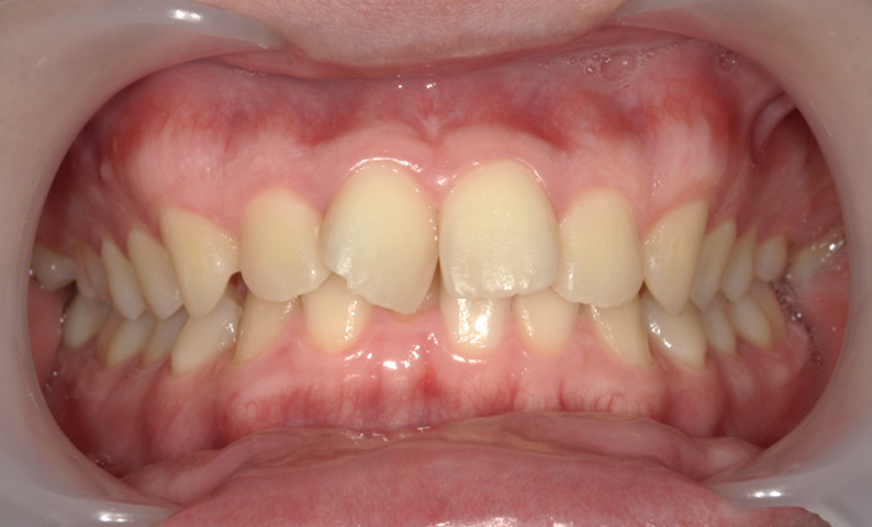 部分矯正 上下の部分矯正の症例写真