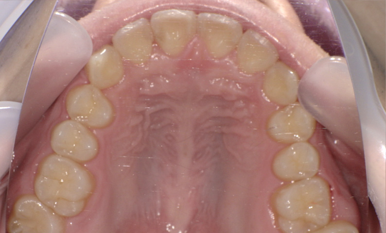 部分矯正 上下の部分矯正の症例写真