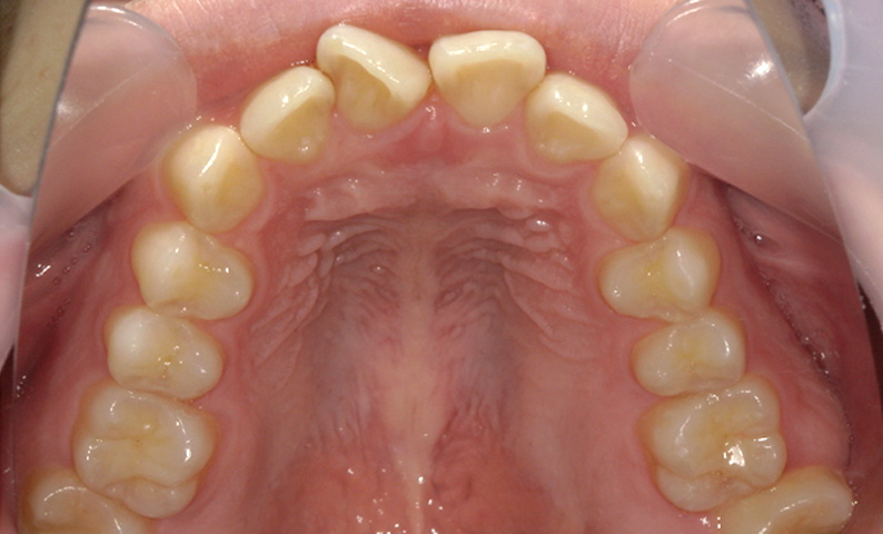 部分矯正 上下の部分矯正の症例写真