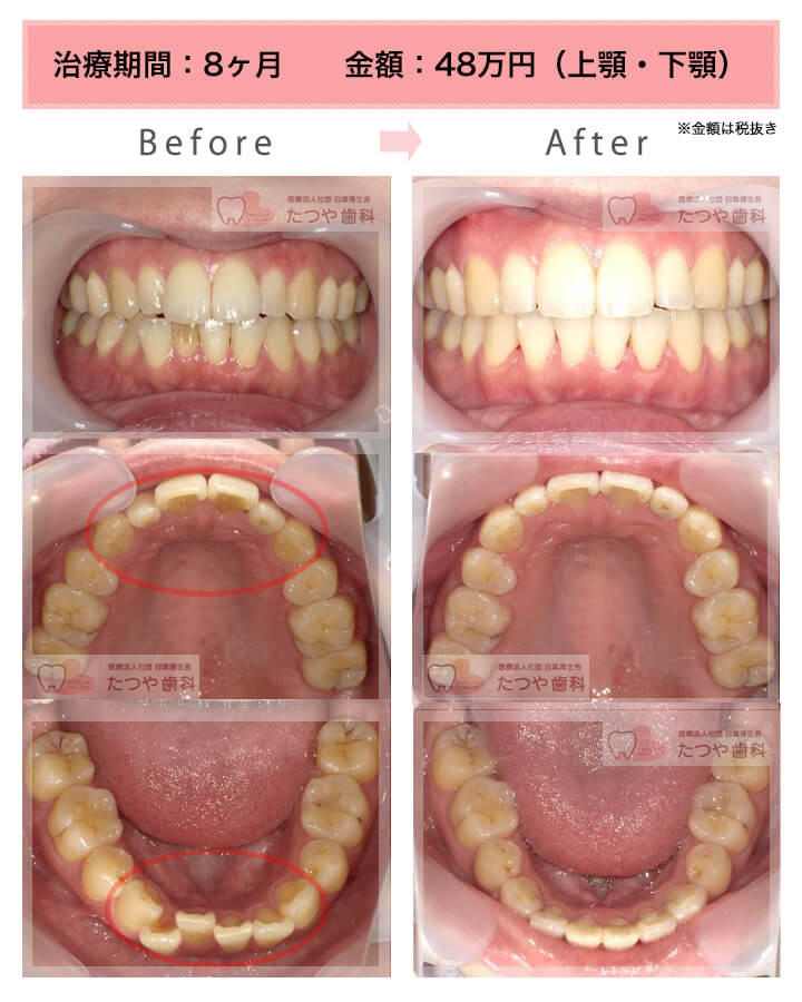 部分矯正の症例　上下の前歯