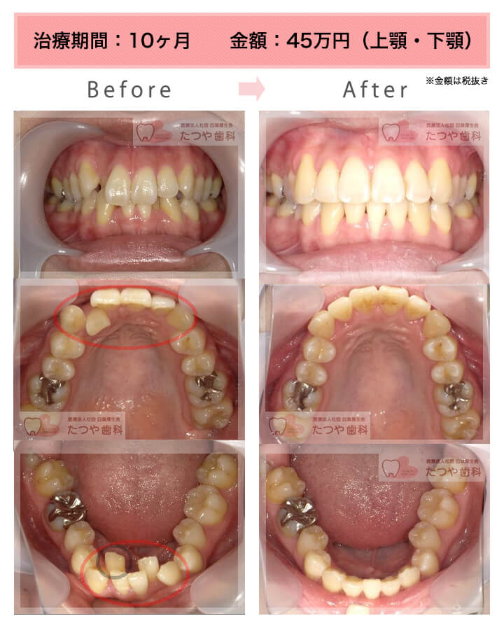部分矯正の症例　上下の前歯