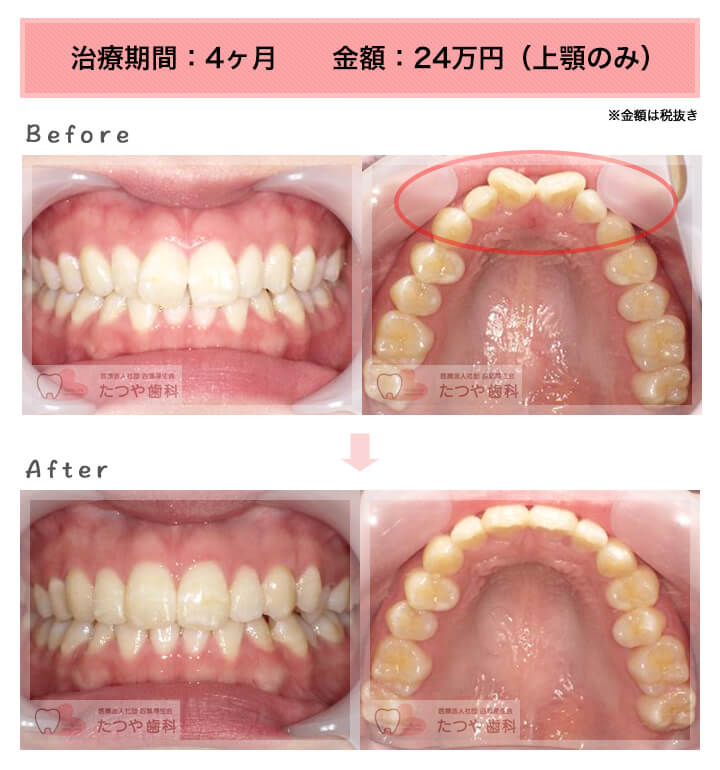 部分矯正の症例　前歯「八の字/V字型」