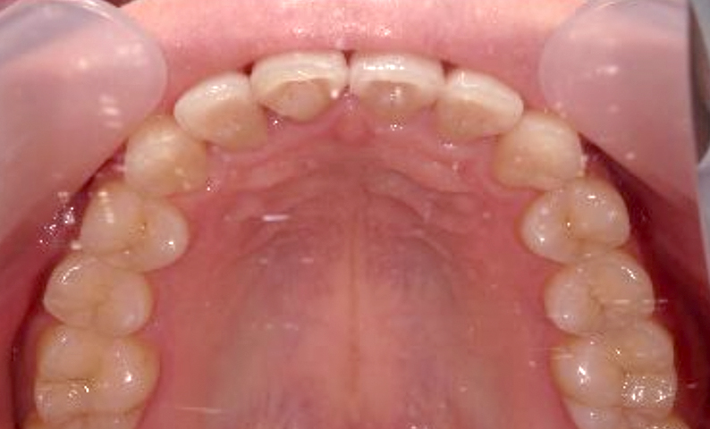 部分矯正 前歯「八の字/V字型」症例写真