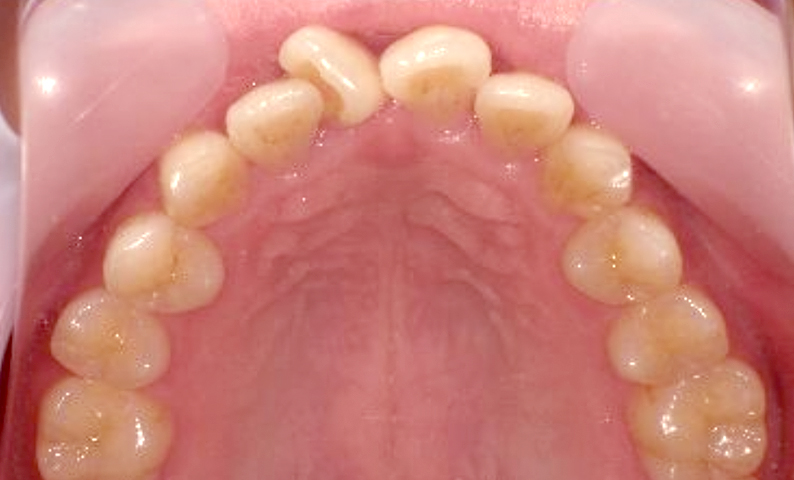 部分矯正 前歯「八の字/V字型」症例写真