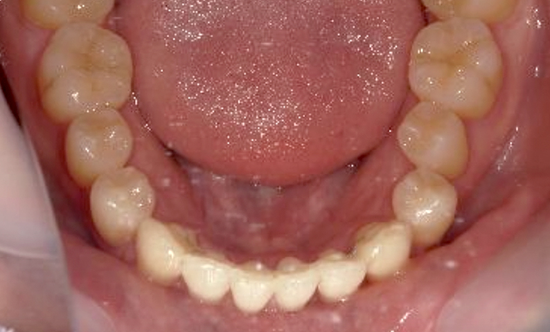 部分矯正 前歯「八の字/V字型」症例写真