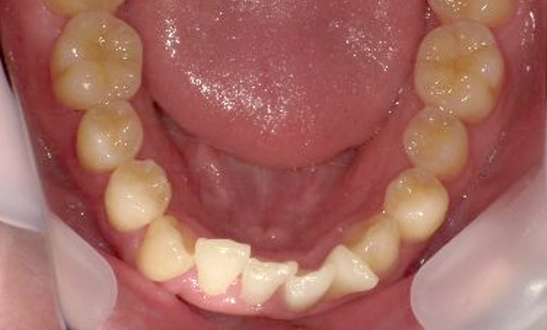 部分矯正 前歯「八の字/V字型」症例写真