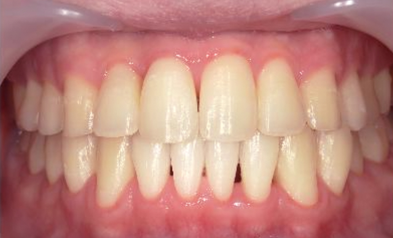 部分矯正 前歯「八の字/V字型」症例写真