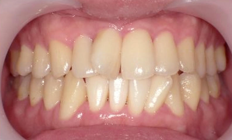 部分矯正 前歯「八の字/V字型」症例写真