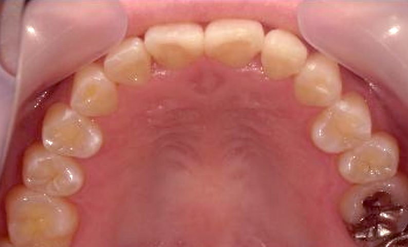 部分矯正 前歯「八の字/V字型」症例写真