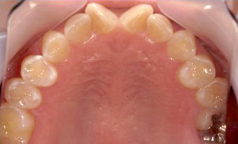 部分矯正 前歯「八の字/V字型」症例写真