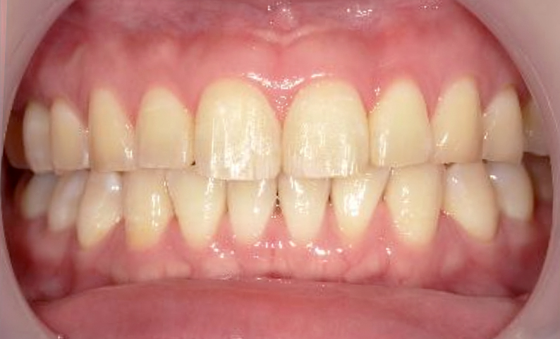 部分矯正 前歯「八の字/V字型」症例写真