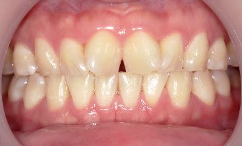 部分矯正 前歯「八の字/V字型」症例写真