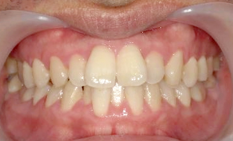 部分矯正 前歯「八の字/V字型」症例写真