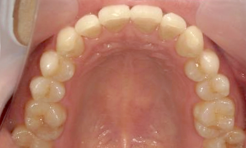 部分矯正 前歯「八の字/V字型」症例写真