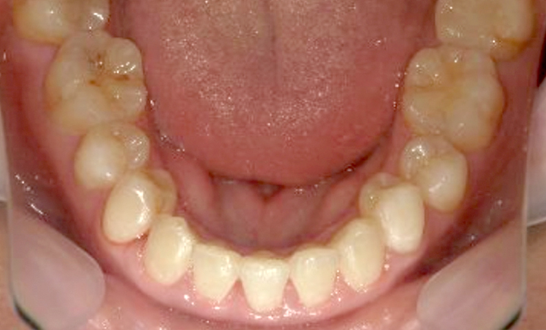 部分矯正 前歯「八の字/V字型」症例写真