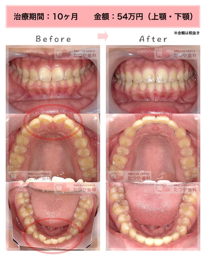 部分矯正の症例　前歯「八の字/V字型」