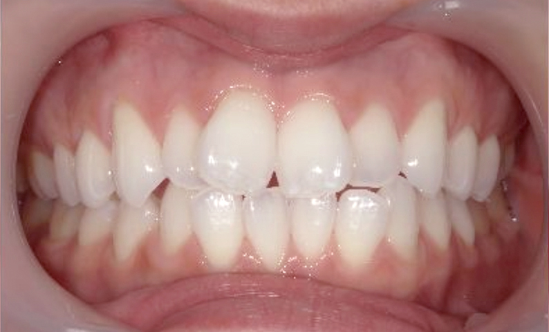 部分矯正 前歯「八の字/V字型」症例写真