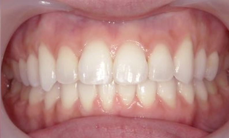 部分矯正 前歯「八の字/V字型」症例写真