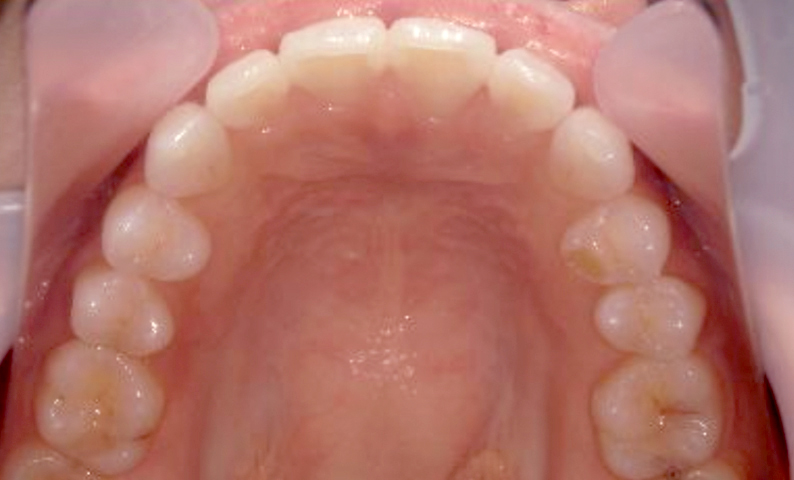 部分矯正 前歯「八の字/V字型」症例写真