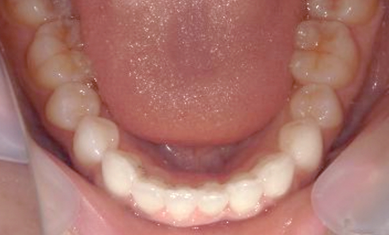 部分矯正 前歯「八の字/V字型」症例写真