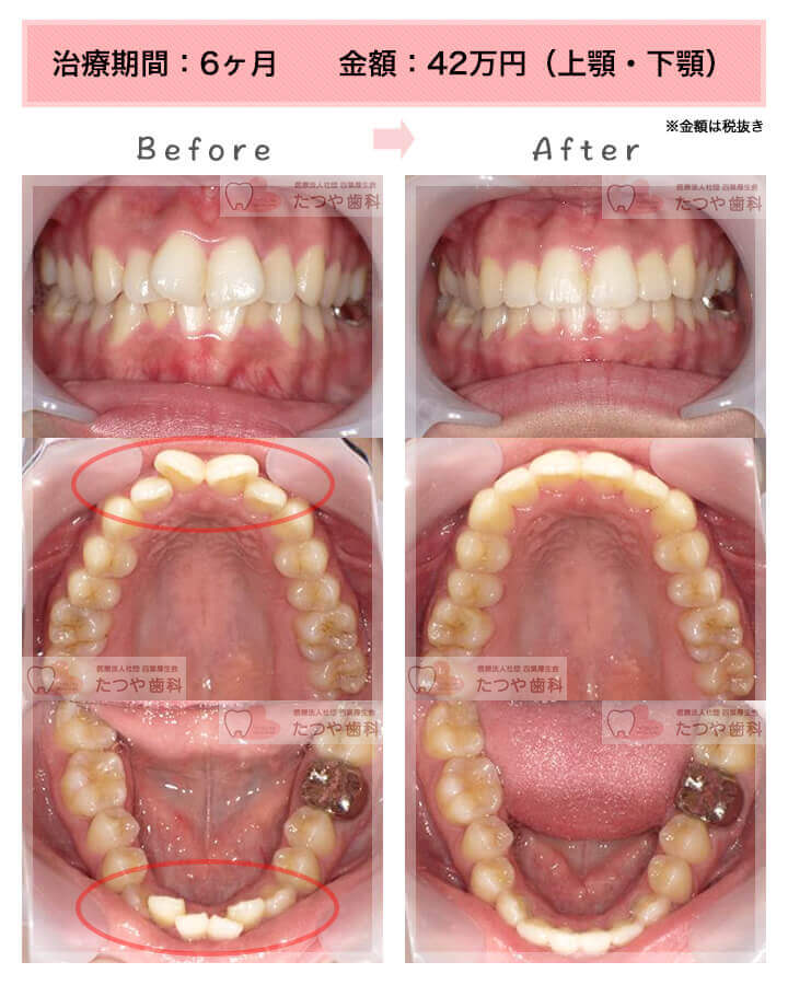 部分矯正の症例　前歯「八の字/V字型」
