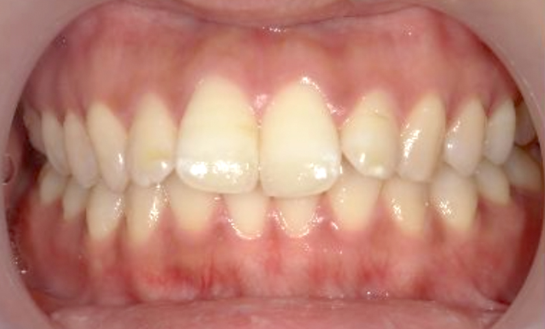 部分矯正 前歯「八の字/V字型」症例写真