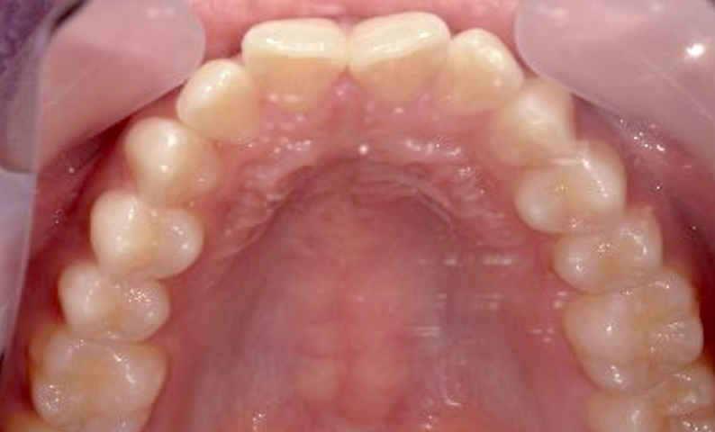 部分矯正 前歯「八の字/V字型」症例写真