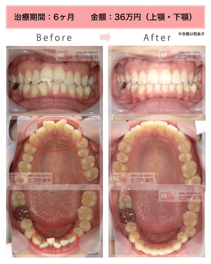 部分矯正の症例　前歯「八の字/V字型」