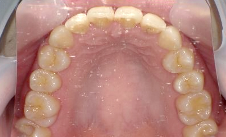 部分矯正 前歯「八の字/V字型」症例写真