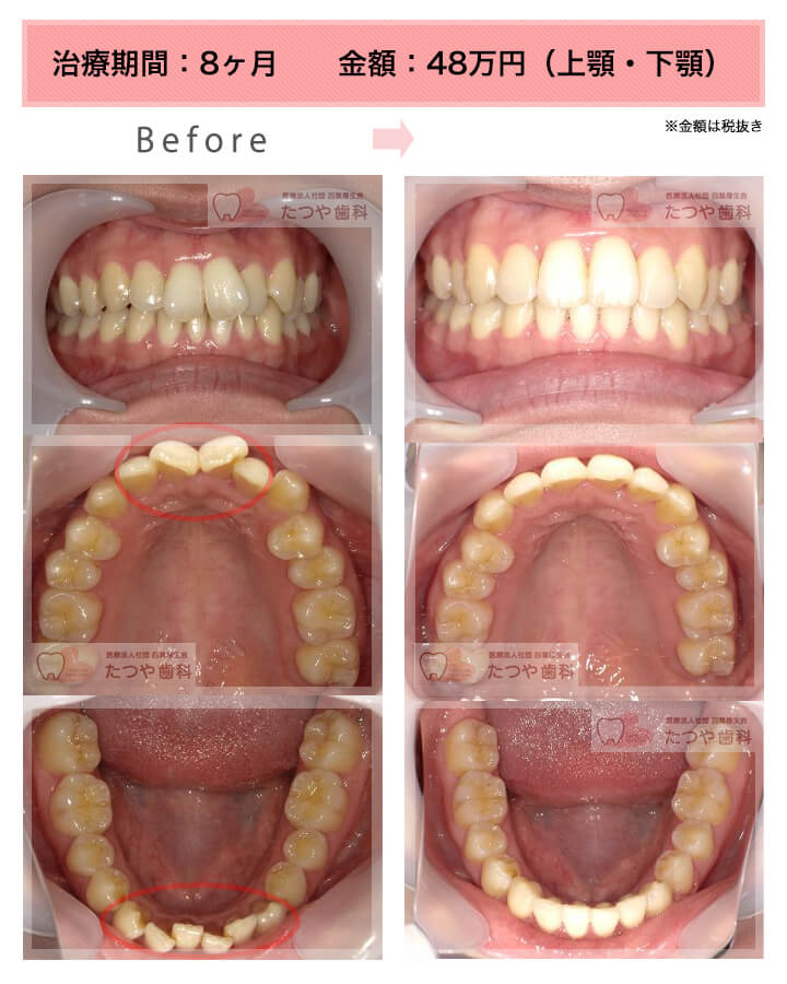 部分矯正の症例　前歯「八の字/V字型」