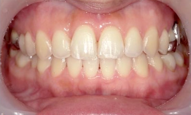 部分矯正 前歯「八の字/V字型」症例写真