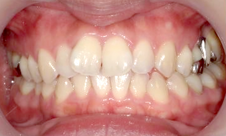 部分矯正 前歯「八の字/V字型」症例写真