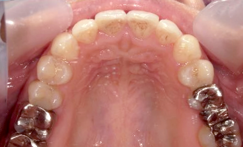 部分矯正 前歯「八の字/V字型」症例写真