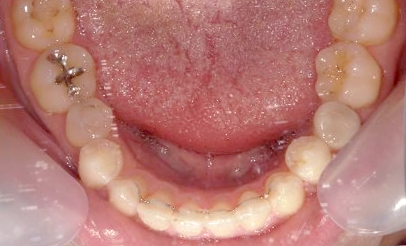 部分矯正 前歯「八の字/V字型」症例写真