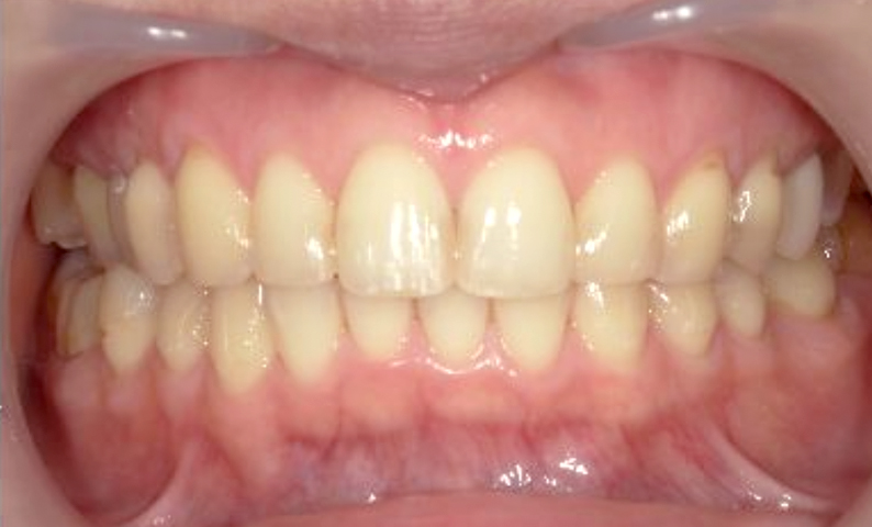 部分矯正 前歯「八の字/V字型」症例写真