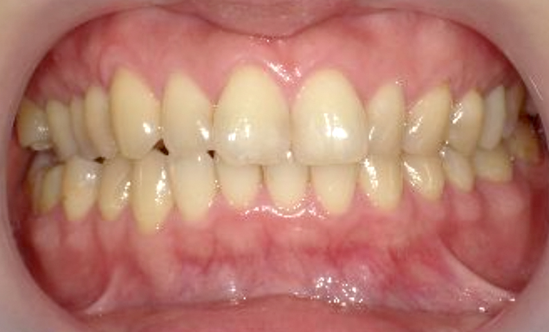 部分矯正 前歯「八の字/V字型」症例写真