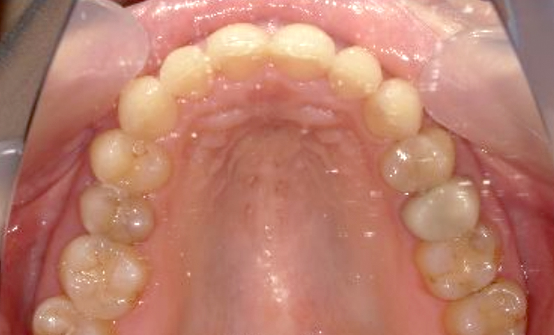 部分矯正 前歯「八の字/V字型」症例写真