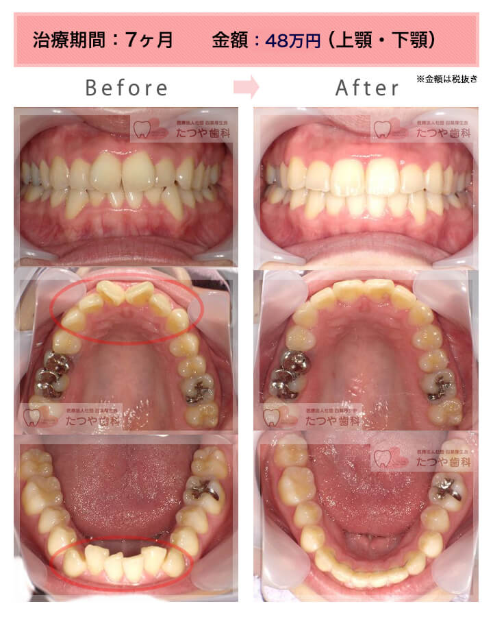 部分矯正の症例　前歯「八の字/V字型」