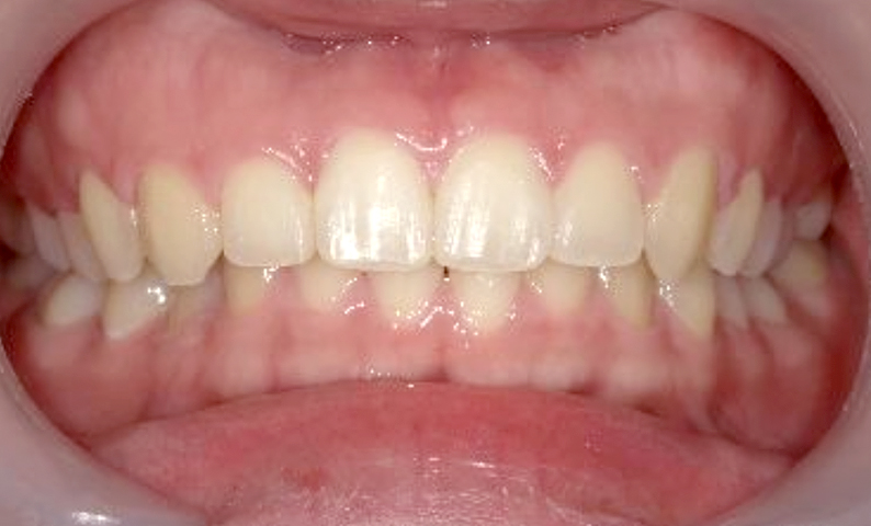 部分矯正 前歯「八の字/V字型」症例写真