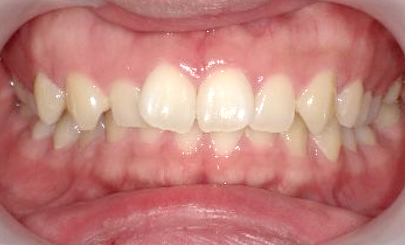 部分矯正 前歯「八の字/V字型」症例写真