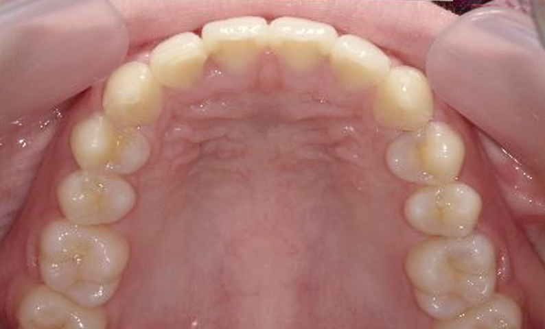 部分矯正 前歯「八の字/V字型」症例写真