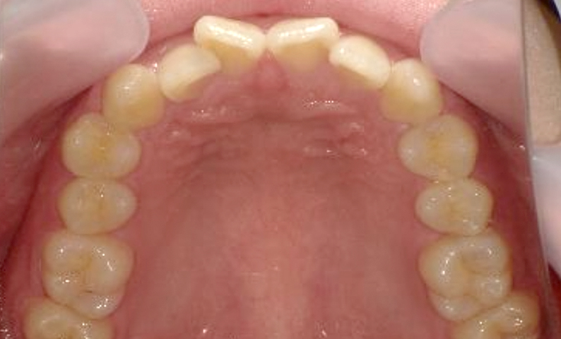 部分矯正 前歯「八の字/V字型」症例写真