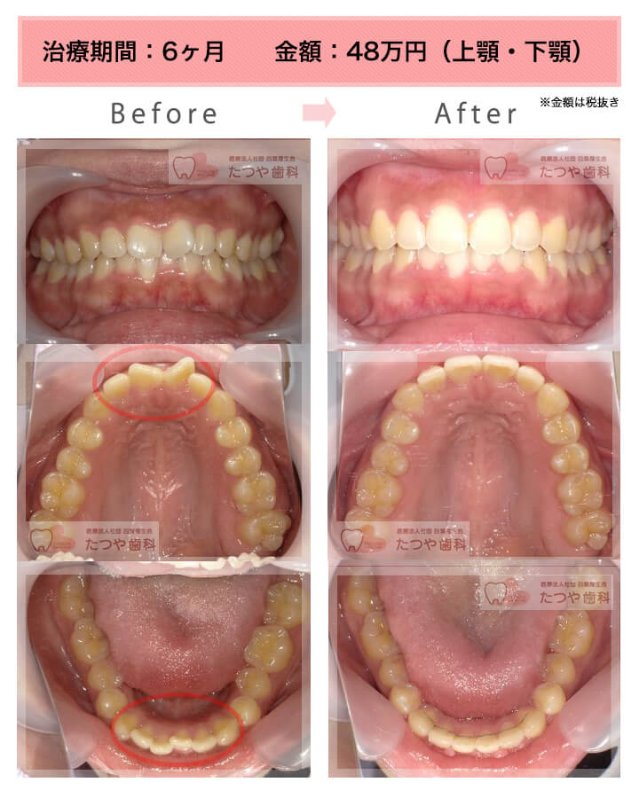 部分矯正の症例　前歯「八の字/V字型」